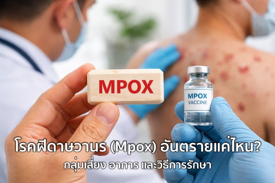 Mpox: ประเมินความเสี่ยงจากการสัมผัส ไม่ตีตราคู่นอน